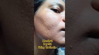 Day32 Using Tretinoin 0025 cream viralvideo tretinoin skincare shorts youtubeshorts [upl. by Omora]