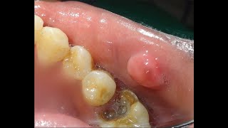 Hyperplastic amp Neoplastic lesions of oral cavity Part 1 [upl. by Coco]