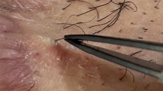 Ingrown hair removal [upl. by Eadrahs]