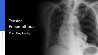 Tension Pneumothorax Explanation of Chest Xray Findings [upl. by Tala]