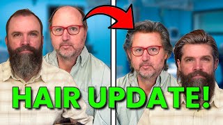 Hair Transplant in Turkey UpdateGuide  One Year Later [upl. by Sawyer]