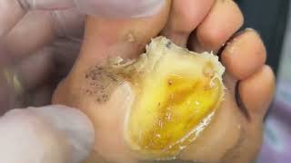 Pedicure video03vertical plantaris，plantar wart [upl. by Abijah]