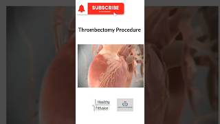 Thrombectomy Procedure  HealthyFitFusion195 shorts viralshorts medicaleducation facts live [upl. by Vinni]