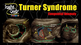 Turner Syndrome  45X  Monosomy X  Ultrasound  Anomaly  Case 276 [upl. by Ennovehs]