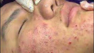 3 Huge blackhead removal from nose old aged blackheads removal  blackheads new this week 2023 [upl. by Spatola641]