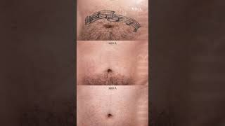 Does Laser Tattoo Removal cause scars [upl. by Miller]