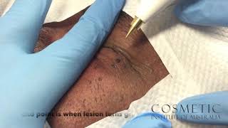 dermatosis papulosa nigra removal with radio frequency [upl. by Humfrey]