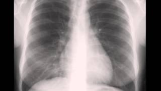 Right Middle Lobe Atelectasis [upl. by Santana541]