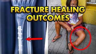 Fracture Healing Outcomes Union Delayed Union Non Union Malunion Refracturing All Explained [upl. by Skier848]