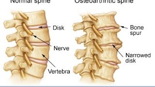 Anatomy of Spinal Arthritis Explained by Top Pain Doctor in Las Vegas Nevada [upl. by Ynner]