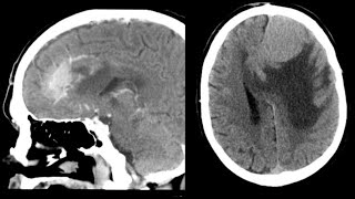 15NeuroradiologyCNSintersting casesCTMRIradiopediaradiologistmedicalimagefrcrtutorials [upl. by Asoral]