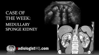 Case of the Week Medullary Sponge Kidney Ultrasound amp CT [upl. by Barton]