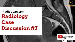 Adenomyosis  Imaging approach Case based  Radiology Board Review Case [upl. by Ofilia391]