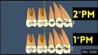 Extracción de segundos premolares en ortodoncia [upl. by Kara-Lynn235]