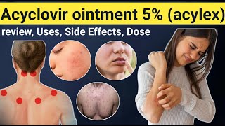 Acyclovir Ointment Uses  Review Acylex ointment uses Side effects contraindications [upl. by Jimmy]