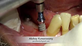 Straumann Tissue Level Implant with prosthesis [upl. by Nyrhtakyram]