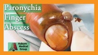 Paronychia Fingernail Abscess Infection Treatment  Auburn Medical Group [upl. by Amihc626]