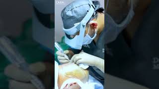 Viral Hair Transplant Surgery at Cara Clinic [upl. by Ansev]