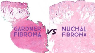 Gardner fibroma vs Nuchaltype fibroma Emory 78 Gardner syndrome familial adenomatous polyposis [upl. by Jaeger]