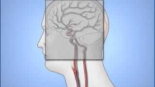 Diagnostic Cerebral Angiography [upl. by Terr]