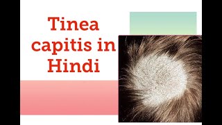 Tinea capitis in Hindi  Black dot  grey patch  kerion and favus In Hindi [upl. by Symer]