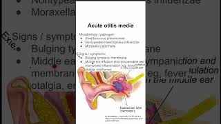 Acute otitis media [upl. by Eixirt813]