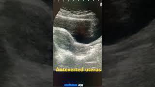 Anteverted uterus ultrasound shortfeed medical uterus pelvic pelvis study shortsviral short [upl. by Eneri]