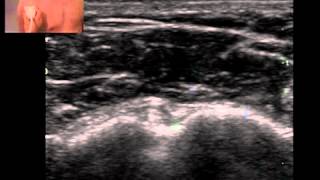 Musculoskeletal Ultrasound Shoulder 1 anterior transverse scan in neutral position [upl. by Tiffie754]