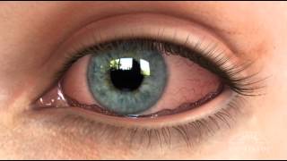 Conjunctivochalasis CCH Dry Eye Animation [upl. by Hras]