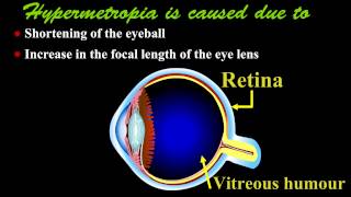 Hypermetropia or Hyperopia [upl. by Northway]