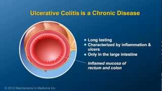 What is Ulcerative Colitis [upl. by Gio]