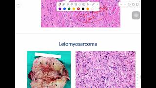 MSS pathology lab 1  part 4 [upl. by Anaihr970]