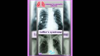 Loffler s syndrome Parasitic infectionEosinophilic pneumonia🩸worms👍Parasitology👍🔬✅ [upl. by Campney832]