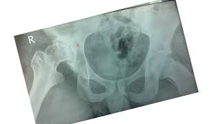 TOTAL HIP REPLACEMENT FOR ACETABULAR DYSPLASIA [upl. by Carlita796]