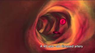 What is atherosclerosis [upl. by Floris42]