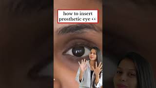 how to insert a prosthetic eye in Hindi Swaineyeclinic shorts optometrist doctor medicalstudent [upl. by Tannenbaum]