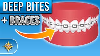 Braces Overbite Overjet Underbite Crossbite amp Open Bite Explained [upl. by Dnaltiak]