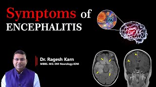 Encephalitis Symptoms Early Warning Signs You Shouldnt Ignore  Dr Ragesh Karn encephalitis [upl. by Rawde]