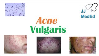 Acne Vulgaris  Causes Pathogenesis Influencing Factors Diagnosis Treatment and Complications [upl. by Hbaruas]