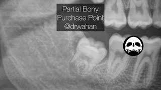 Partial Bony Impaction Extraction Using Purchase Point with Cogswell B Elevator [upl. by Brezin]