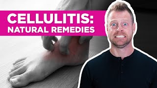 Are There Natural Remedies for Cellulitis [upl. by Aehtna]