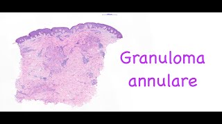 Granuloma annulare [upl. by Gilud314]