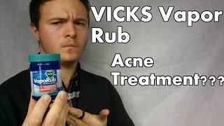 VICKS Vapor Rub ACNE TREATMENT GOOD PRODUCT FOR TEENS When Where amp How To Apply [upl. by Etterual837]