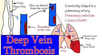 Deep vein Thrombosis DVT  Symptoms diagnosis and treatment Homan sign [upl. by Sirtaeb282]