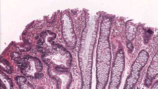 Colon tubular adenoma demonstrating low grade dysplasia  Microscopic diagnosis [upl. by Drahser]