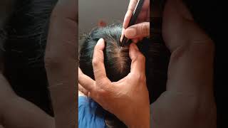 MOST satisfying white hair removal 043relaxing stressreliver itchyscalp [upl. by Ajay]