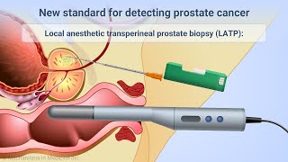 Transperineal Prostate Biopsies Under Local Anesthesia [upl. by Leavelle154]