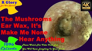 The Mushrooms Ear Wax Its Make Me None Hear Anything🤷‍♂️New Video 1096 ear health newvideo [upl. by Odnarb742]