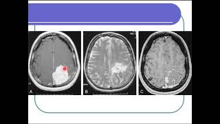 Introduction to interventional neuroradiology [upl. by Aushoj174]