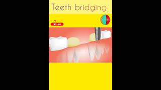 Teeth Bridging Dental surgery BDS [upl. by Gaillard]